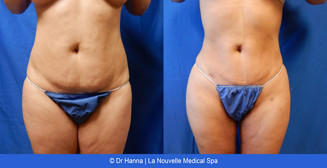 vaser liposuction smartlipo before after photos, Dr. Hanna La Nouvelle Medical Spa, Oxnard, Ventura county female back  